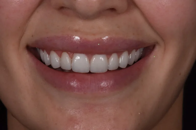 Front tooth gap closed with 20 feldspathic porcelain veneers, Bedford Dental Group, Beverly Hills