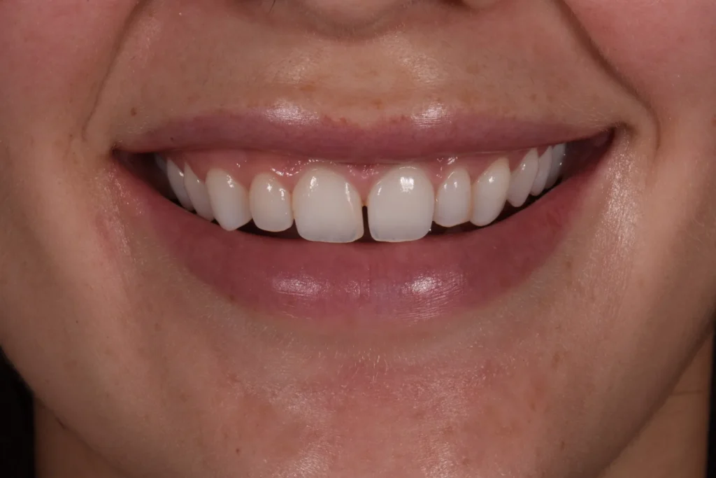 Before treatment: gap between the upper front teeth and small-looking teeth, Bedford Dental Group patient in Beverly Hills