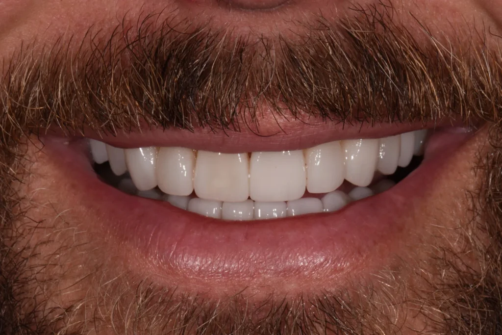 After treatment: balanced smile with 20 e.max porcelain veneers replacing a fractured crown, Bedford Dental Group, Beverly Hills