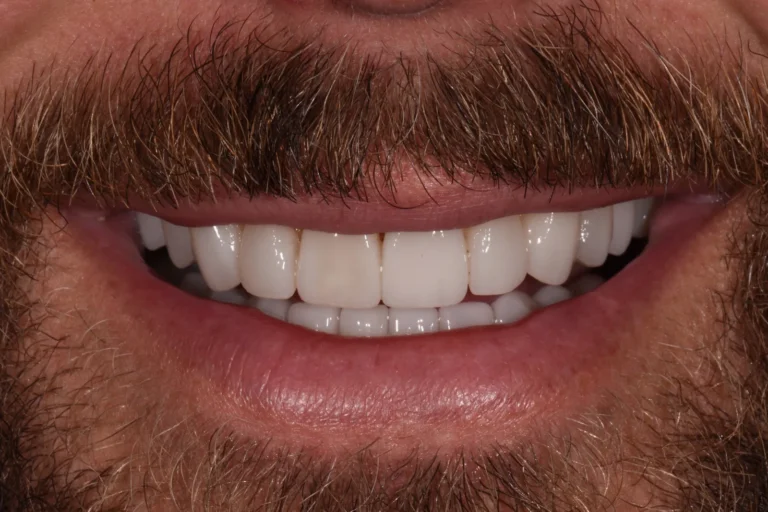 Balanced smile with 20 e.max porcelain veneers replacing a fractured crown, Bedford Dental Group, Beverly Hills