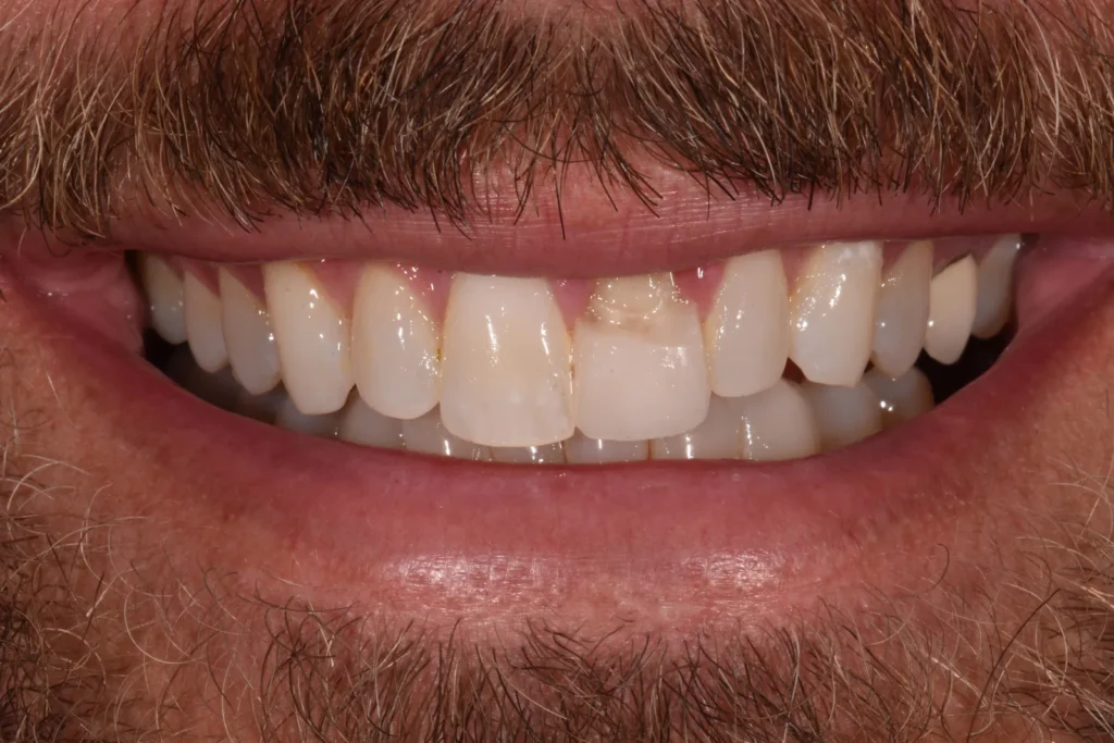 Before treatment: fractured crown, discolored crown and front teeth of uneven size, Bedford Dental Group patient in Beverly Hills