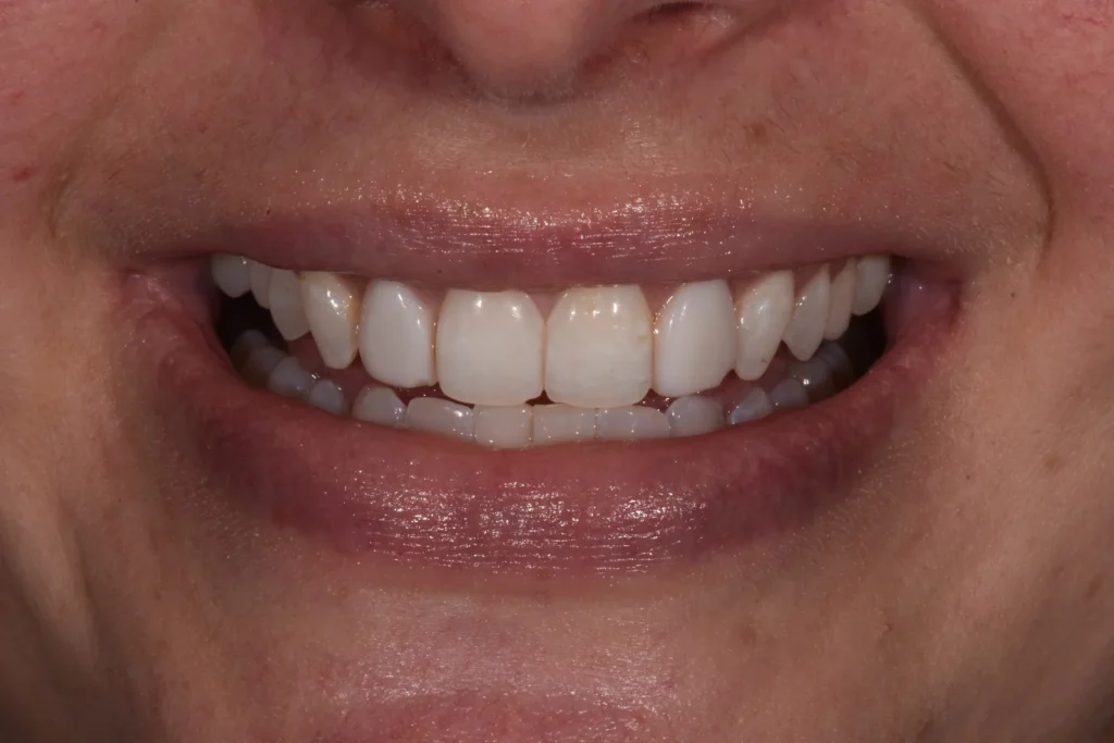 Before treatment: discolored teeth with two existing veneers that do not match, Bedford Dental Group patient in Beverly Hills