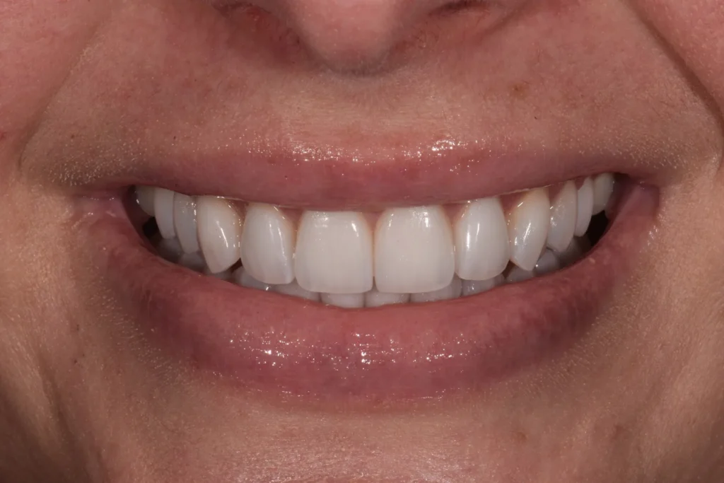 After treatment: 20 feldspathic porcelain veneers in place of mismatched veneers on discolored teeth, Bedford Dental Group, Beverly Hills