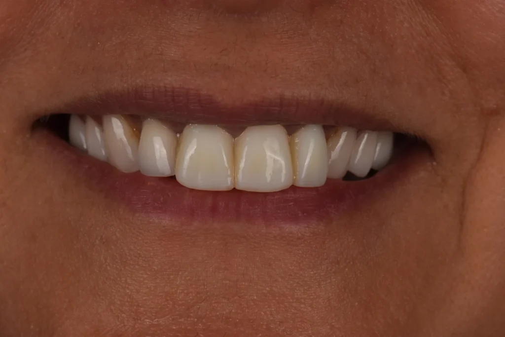 Before treatment: previous veneers the patient felt were too large, with a tilted smile midline, Bedford Dental Group patient in Beverly Hills