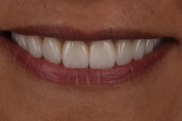 Replacement e.max porcelain veneers with the smile midline in line with the face, Bedford Dental Group, Beverly Hills