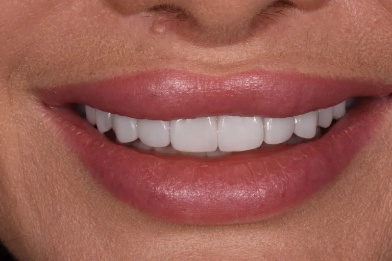 Worn teeth rebuilt with 20 layered e.max veneers and 4 onlays that raised the bite, Bedford Dental Group, Beverly Hills