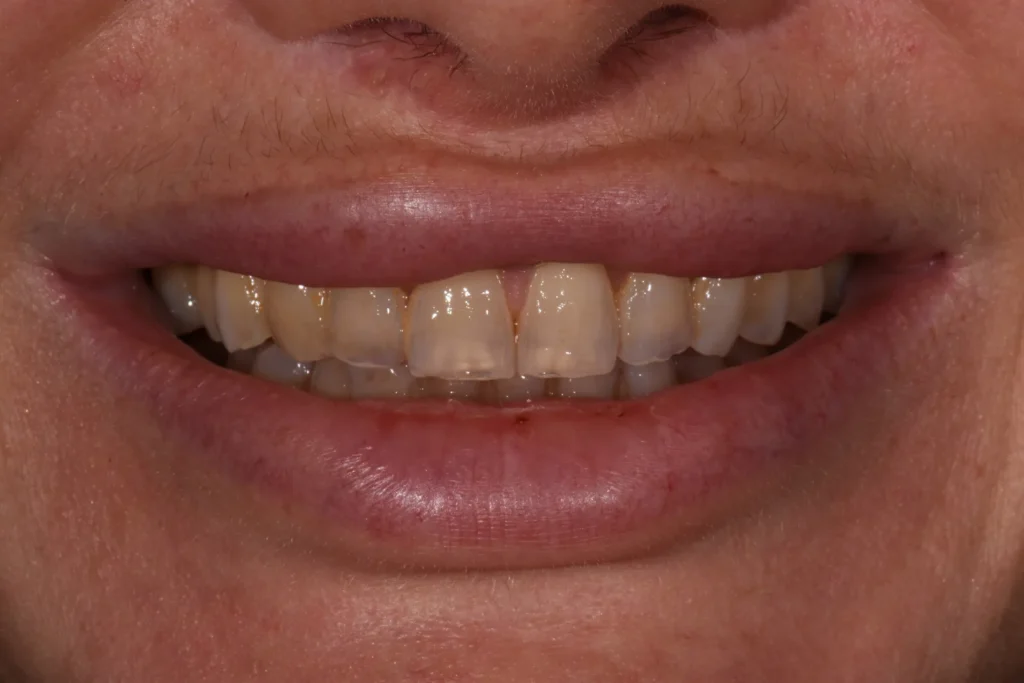 Before treatment: severely worn, thin enamel with yellowed teeth and a worn-down bite, Bedford Dental Group patient in Beverly Hills