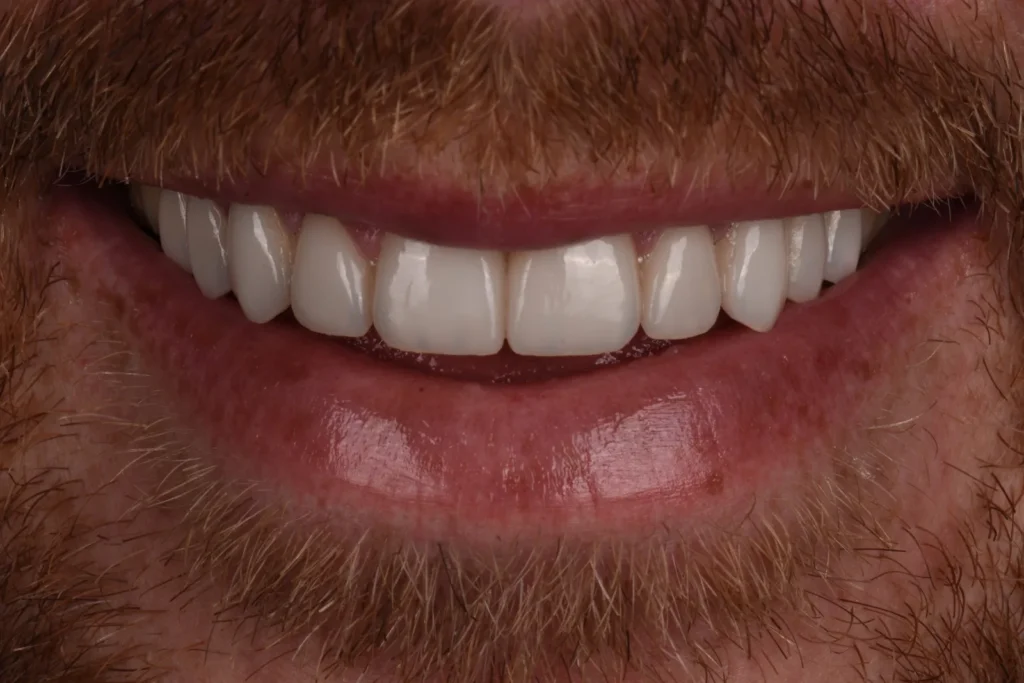 After treatment: worn teeth restored with 20 feldspathic porcelain veneers, Bedford Dental Group, Beverly Hills