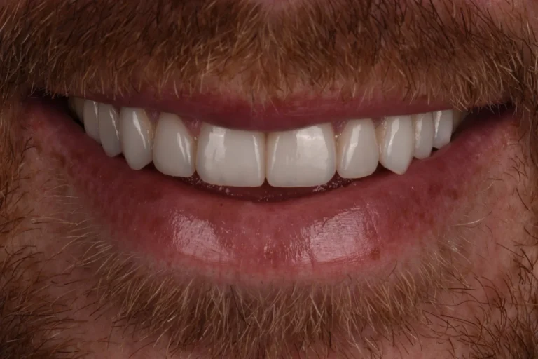 Worn teeth restored with 20 feldspathic porcelain veneers, Bedford Dental Group, Beverly Hills