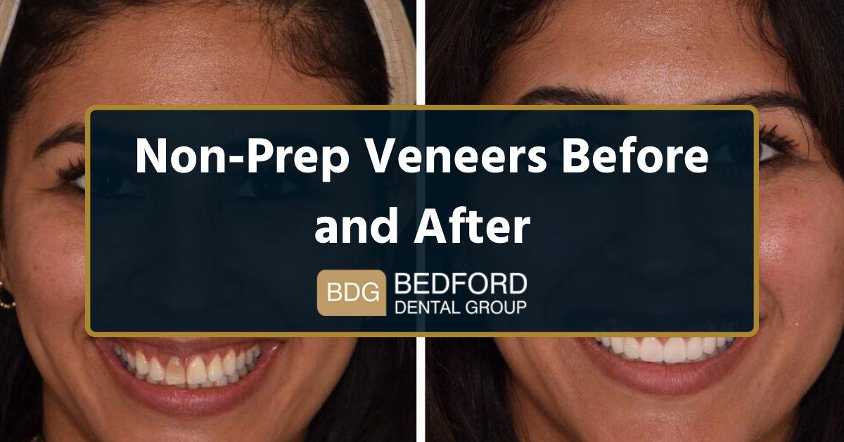 Non-prep veneers before and after